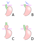 124px hiatus hernia svg