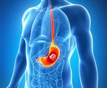 Cancer estomac