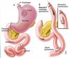 Gastrectomie totale