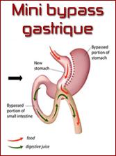 Minibypassgastrique